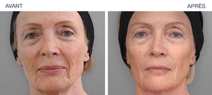 Revitalift soin anti rides instantané