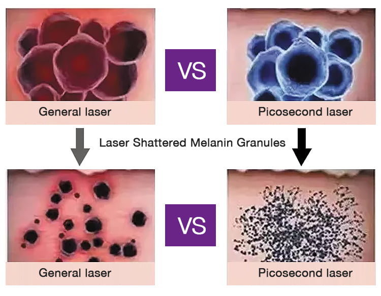 Laser pico vs Q-switched