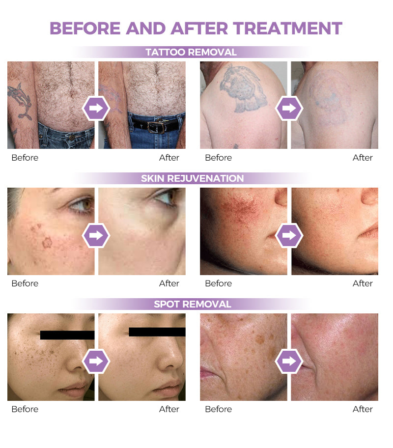 Laser pico vs Q-switched