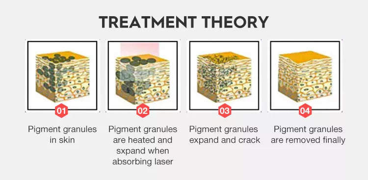 Détatouage au laser