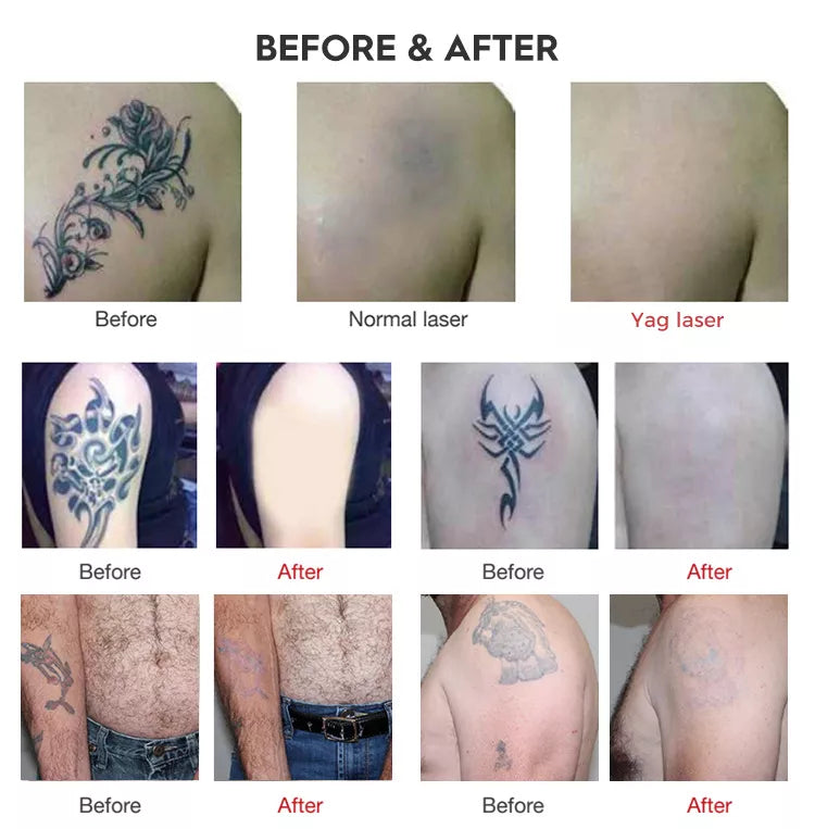 Détatouage au laser