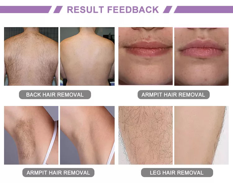 Epilation au laser diode connecté