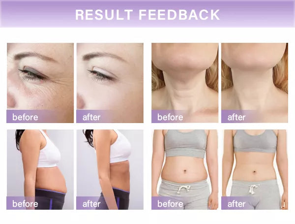 Lifting hifu 12D "NOUVEAU"