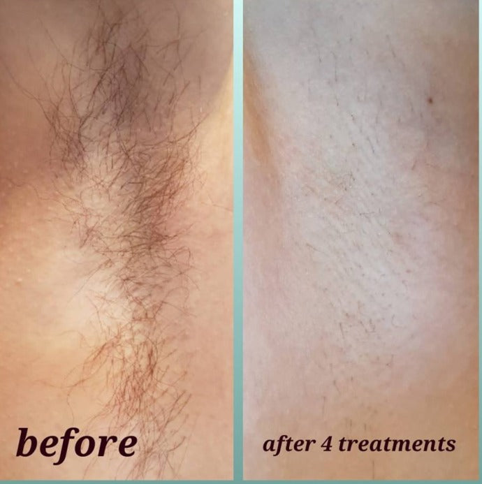 Epilation au laser diode connecté