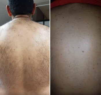 Epilation au laser diode connecté