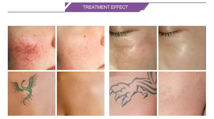 Détatouage au laser